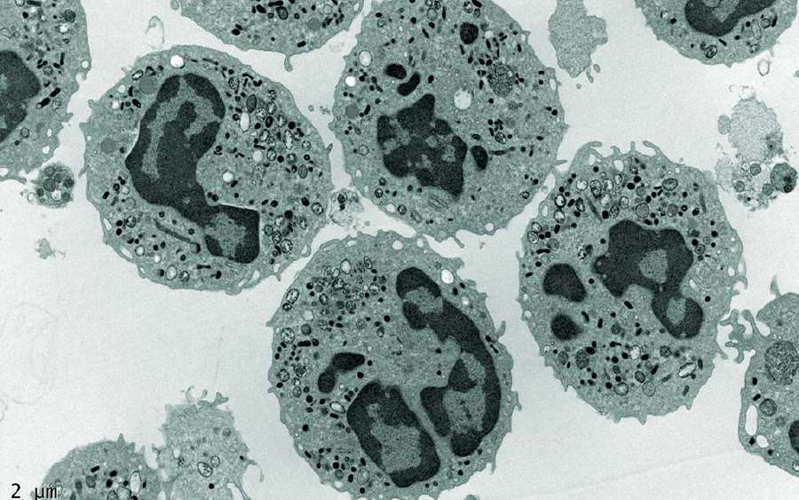 What is Leukaemia?